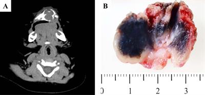 Melanotic Neuroectodermal Tumor of Infancy: A Clinicopathological and BRAF V600E Mutation Study of 11 Cases